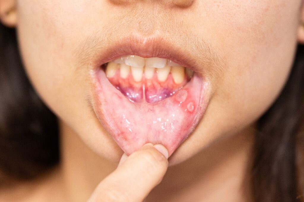 Une fille montrant les aphtes sur sa bouche