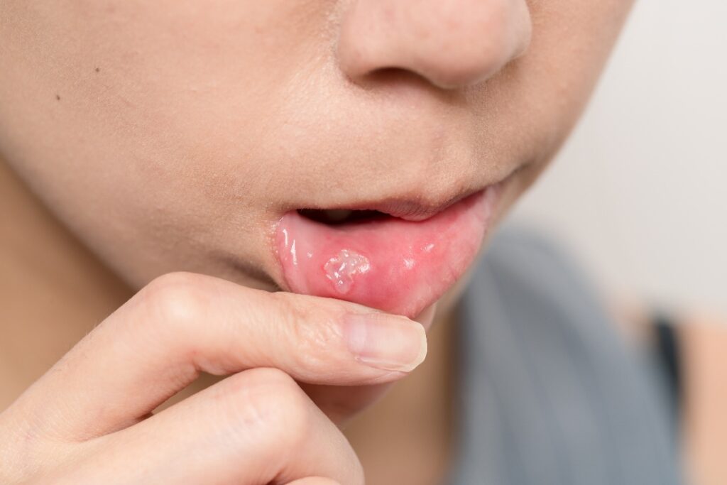 Un petit garçon ayant un aphte buccal