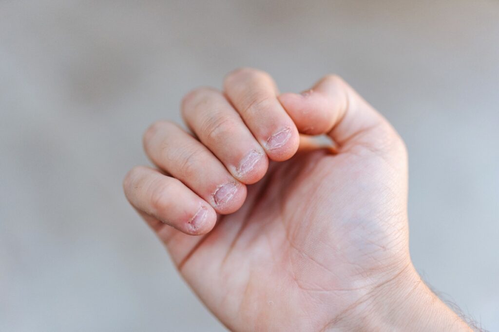 Main d'une personne avec des ongles rongés