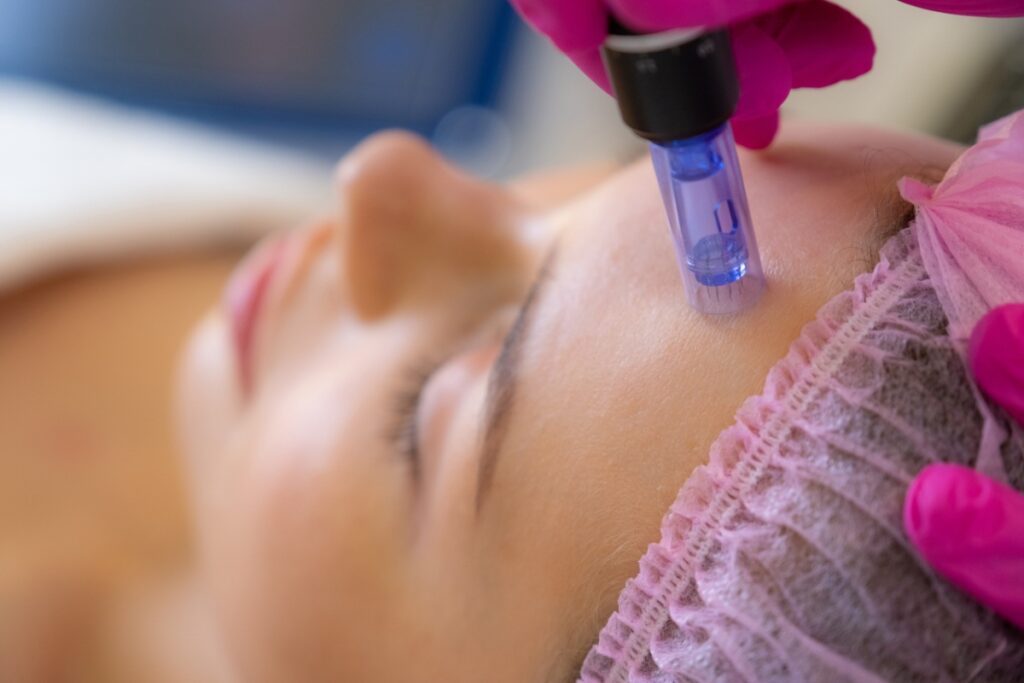 Une femme recevant un soin de visage avec un microneedling